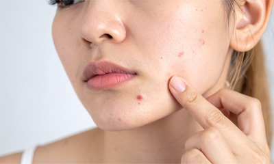 Pimples on face